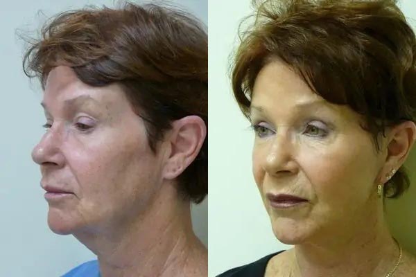 Facelift Case #2032