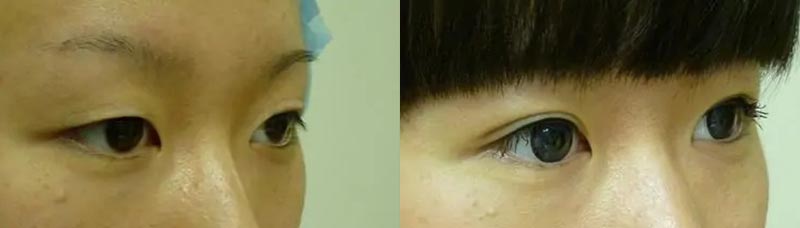 Asian Blepharoplasty (Eyelid Surgery) Case #2057 Asian Blepharoplasty (Eyelid Surgery) Case #2057