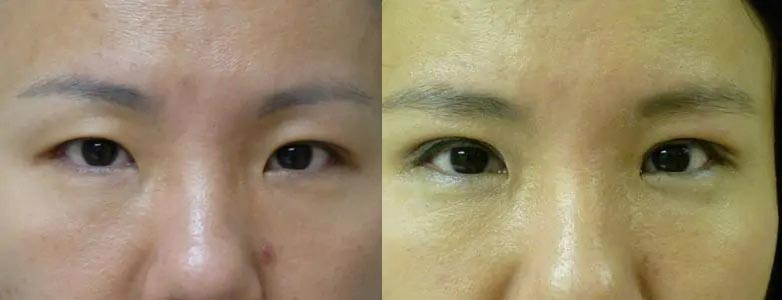 Asian Blepharoplasty (Eyelid Surgery) Case #2062 Asian Blepharoplasty (Eyelid Surgery) Case #2062
