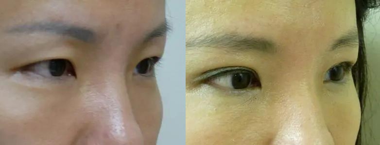 Asian Blepharoplasty (Eyelid Surgery) Case #2062 Asian Blepharoplasty (Eyelid Surgery) Case #2062