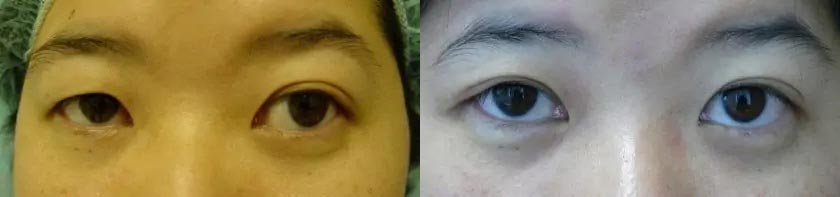 Asian Blepharoplasty (Eyelid Surgery) Case #2067 Asian Blepharoplasty (Eyelid Surgery) Case #2067