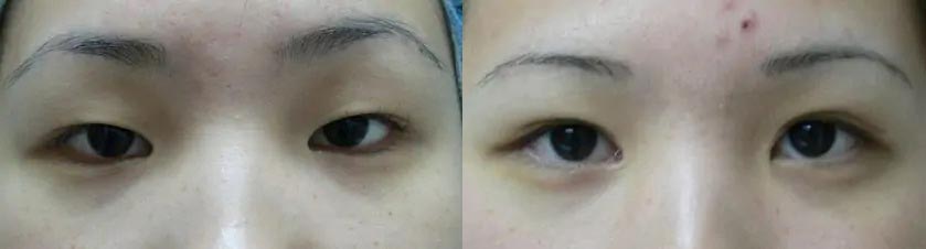 Asian Blepharoplasty (Eyelid Surgery) Case #2070 Asian Blepharoplasty (Eyelid Surgery) Case #2070