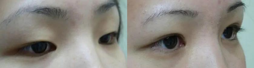 Asian Blepharoplasty (Eyelid Surgery) Case #2070 Asian Blepharoplasty (Eyelid Surgery) Case #2070
