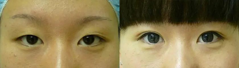 Asian Blepharoplasty at Shine Cosmetic Surgery in West Covina, CA
