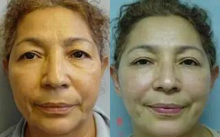 Facelift Case #2041