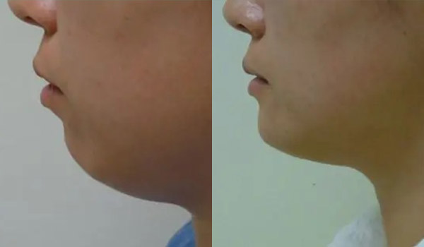 Liposuction Case #1921 Liposuction Case #1921