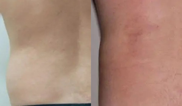 Liposuction Case #1945 Liposuction Case #1945
