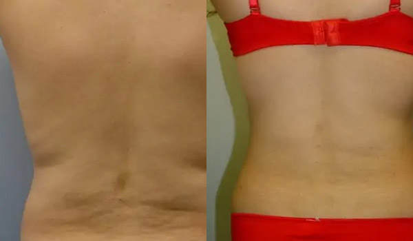 Liposuction Case #1956 Liposuction Case #1956