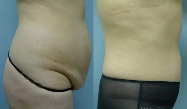 Liposuction Case #2007 Liposuction Case #2007