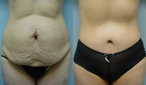 Liposuction Case #2007 Liposuction Case #2007
