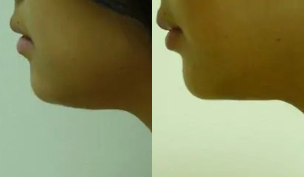 Liposuction Case #1918 Liposuction Case #1918