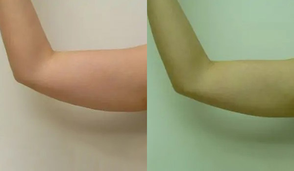 Liposuction Case #1940 Liposuction Case #1940