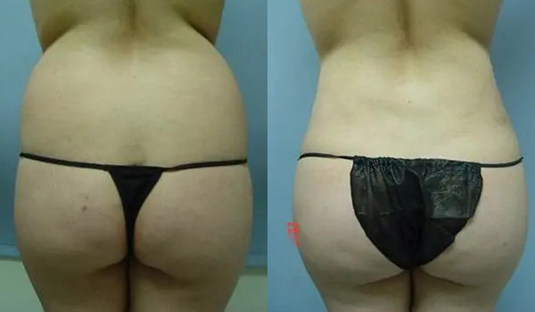 Liposuction Case #1950 Liposuction Case #1950