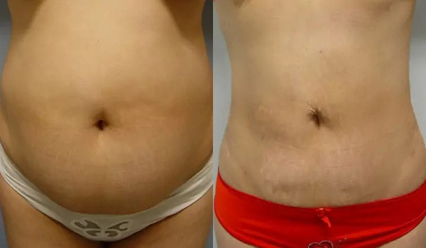 Liposuction Case #1956 Liposuction Case #1956