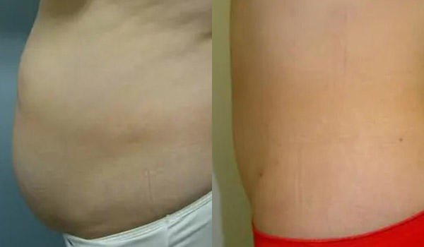 Liposuction Case #1956 Liposuction Case #1956