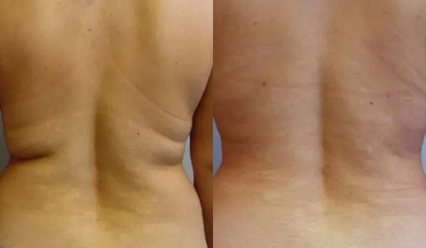 Liposuction Case #1953 Liposuction Case #1953