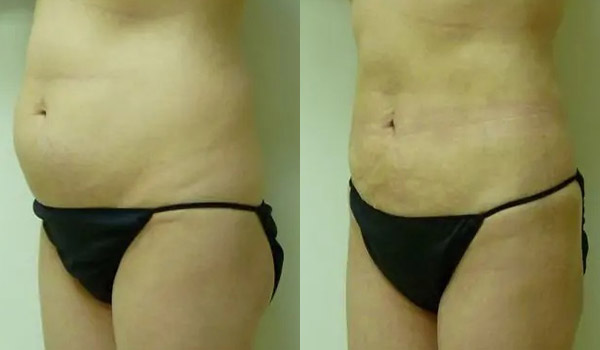 Liposuction Case #1963 Liposuction Case #1963