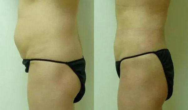 Liposuction Case #1963 Liposuction Case #1963
