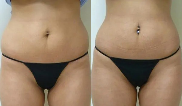 Liposuction Case #1968 Liposuction Case #1968