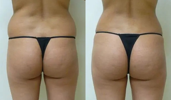Liposuction Case #1968 Liposuction Case #1968