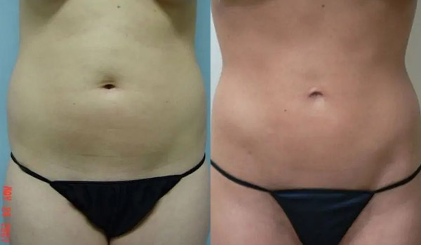 Liposuction Case #1978 Liposuction Case #1978