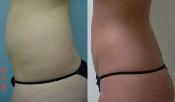 Liposuction Case #1978 Liposuction Case #1978