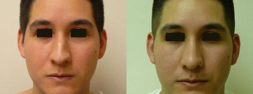 Rhinoplasty Case #2044 Rhinoplasty Case #2044