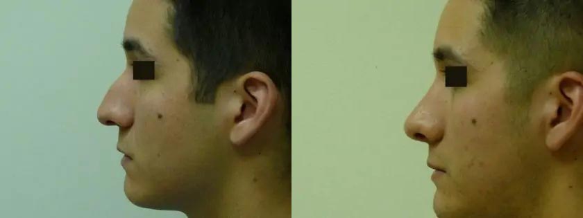 Rhinoplasty Case #2044 Rhinoplasty Case #2044