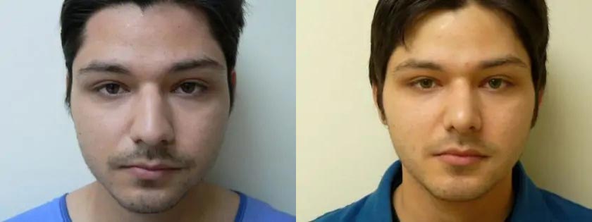 Rhinoplasty Case #2049 Rhinoplasty Case #2049