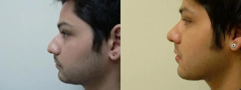 Rhinoplasty Case #2049 Rhinoplasty Case #2049