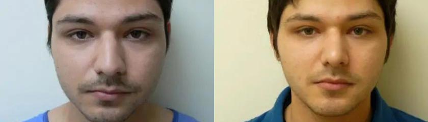 Rhinoplasty at Shine Cosmetic Surgery in West Covina, CA