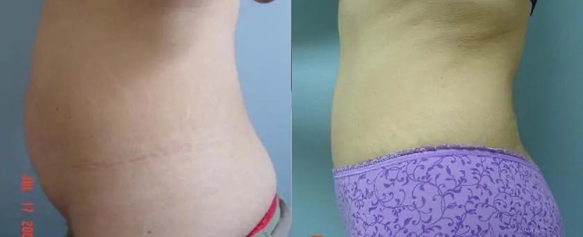 Tummy Tuck Case #2012