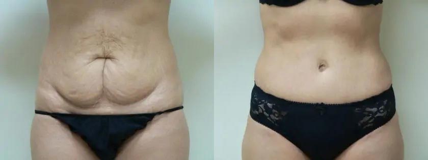 Tummy Tuck Case #2017