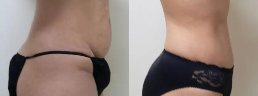Tummy Tuck Case #2017