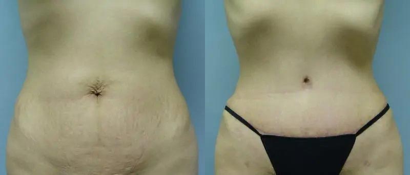 Tummy Tuck Case #2022