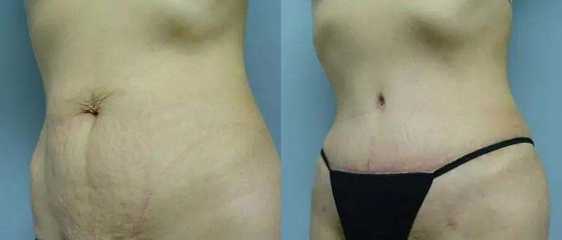 Tummy Tuck Case #2022