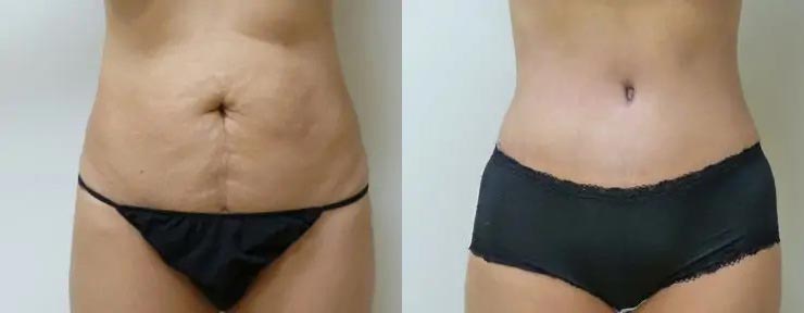Tummy Tuck Case #2027