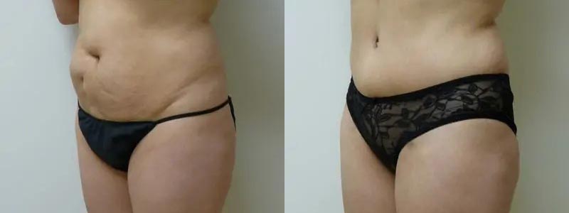 Tummy Tuck Case #1984