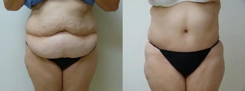 Tummy Tuck Case #1989