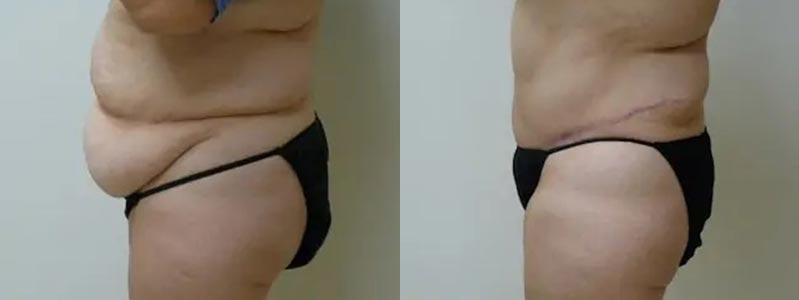 Tummy Tuck Case #1989