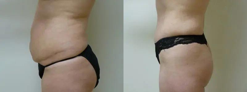 Tummy Tuck Case #1994