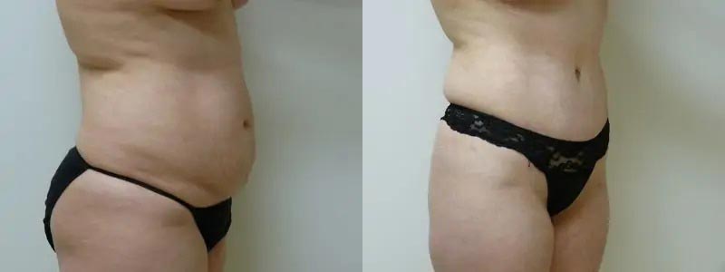 Tummy Tuck Case #1994