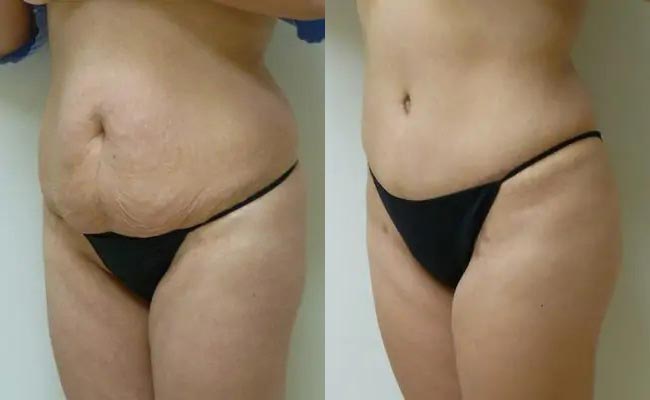 Tummy Tuck Case #1999