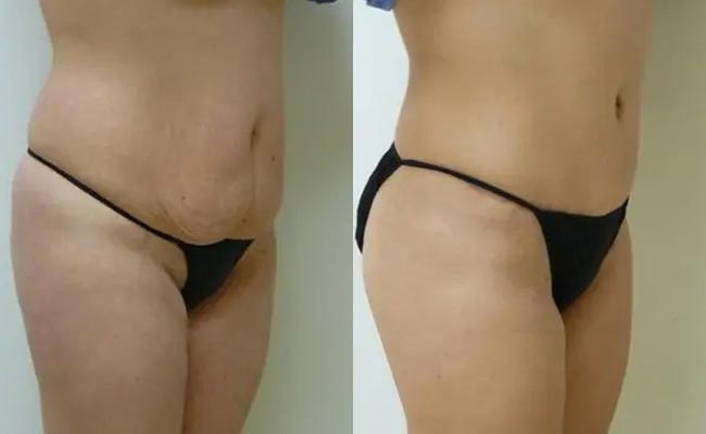 Tummy Tuck Case #1999