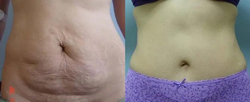 Tummy Tuck Case #2012
