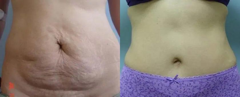 Tummy Tuck at Shine Cosmetic Surgery in West Covina, CA